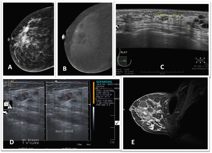 intraductalis papilloma mammogram)