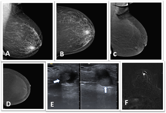 papilloma intraductal multiple