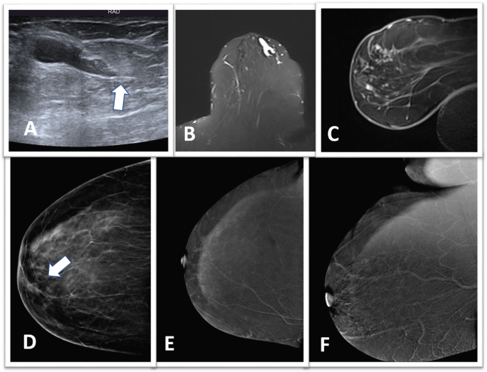 intraductal papillomatosis meaning)