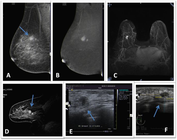 intraductal papilloma mri