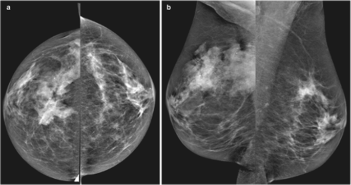 breast cancer digital mammogram