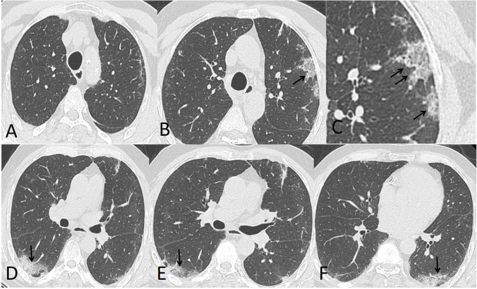 High Resolution Ct Features Of Covid 19 Pneumonia In Confirmed Cases Egyptian Journal Of Radiology And Nuclear Medicine Full Text High Resolution Ct Features Of Covid 19 Pneumonia In Confirmed Cases Egyptian Journal Of Radiology And Nuclear Medicine Full Text