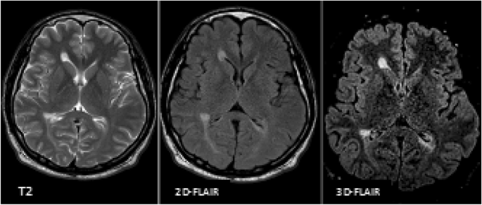 Diagnostic value of 3D-FLAIR magnetic resonance sequence in detection of  white matter brain lesions in multiple sclerosis | Egyptian Journal of  Radiology and Nuclear Medicine | Full Text