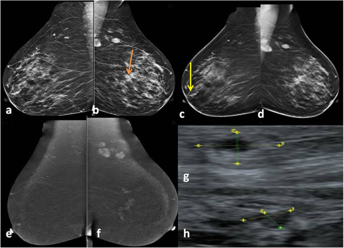 Comparative Study Between Contrast Enhanced Mammography Tomosynthesis And Breast Ultrasound As Complementary Techniques To Mammography In Dense Breast Parenchyma Egyptian Journal Of Radiology And Nuclear Medicine Full Text