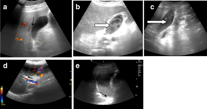 putty air yarn Diagnostic value of abdominal sonography in confirmed COVID-19 intensive  care patients | Egyptian Journal of Radiology and Nuclear Medicine | Full  Text