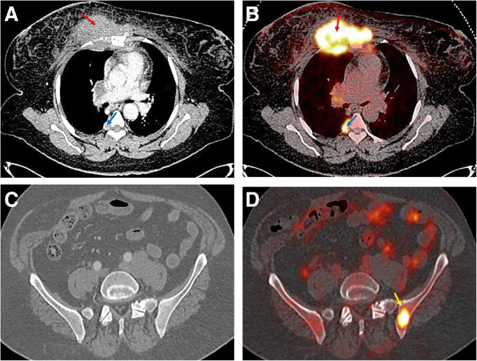 PET/CT and contrast-enhanced CT: making a difference in assessment and  staging of patients with lymphoma | Egyptian Journal of Radiology and  Nuclear Medicine | Full Text