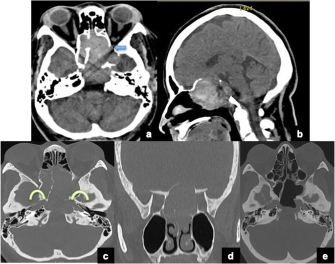 Sphenoid Sinus Aspergilloma Clinically Mimicking As Malignancy A Case Report Egyptian Journal Of Radiology And Nuclear Medicine Full Text