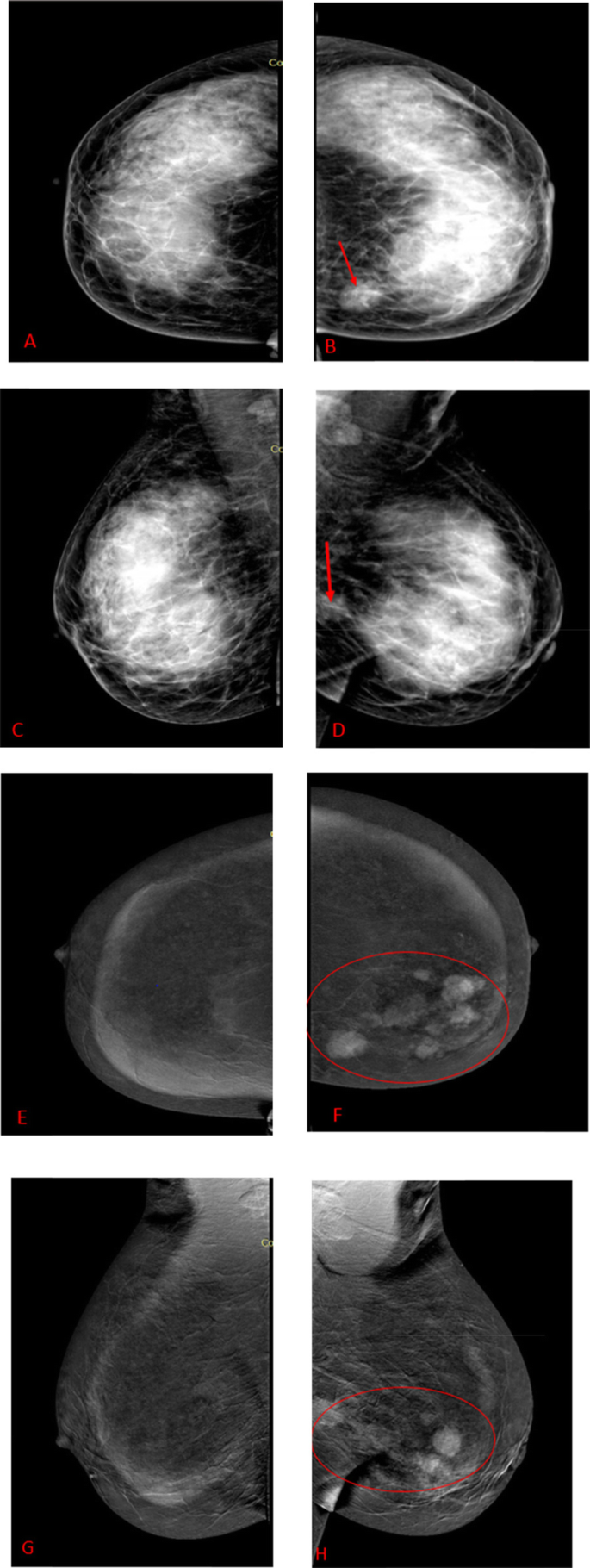 Added Value Of Contrast Enhanced Spectral Mammography In Symptomatic Patients With Dense Breasts Springerlink Added Value Of Contrast Enhanced Spectral Mammography In Symptomatic Patients With Dense Breasts Springerlink
