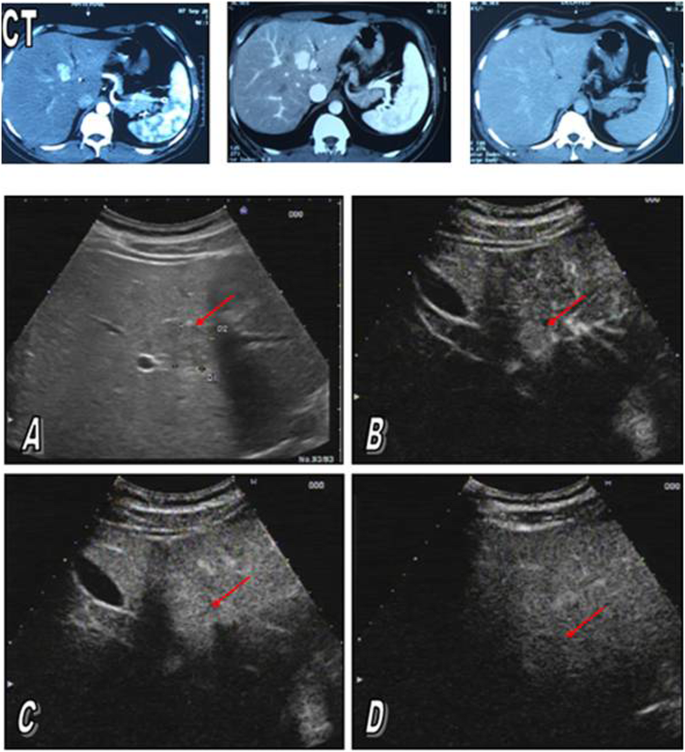 vijver inspanning hobby Characterization of focal liver lesions using sulphur hexafluoride (SF6)  microbubble contrast-enhanced ultrasonography | Egyptian Journal of  Radiology and Nuclear Medicine | Full Text