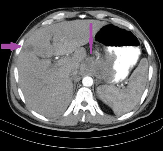 Gastric cancer ct scan, Stomach (Gastric) Cancer Treatment enterobius vermicularis habitat