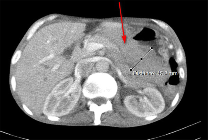 gastric cancer on ct