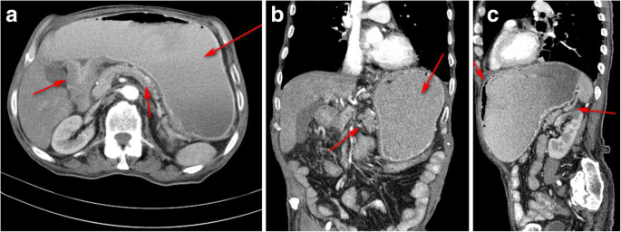 Gastric cancer on endoscopy - Gastric cancer ct scan