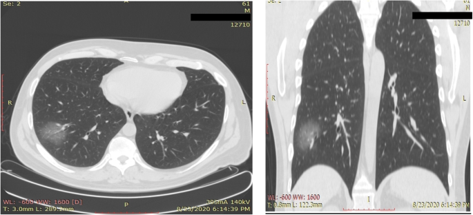 Spectrum Of Ct Appearance And Ct Severity Index Of Covid 19 Pulmonary Infection In Correlation With Age Sex And Pcr Test An Iraqi Experience Egyptian Journal Of Radiology And Nuclear Medicine