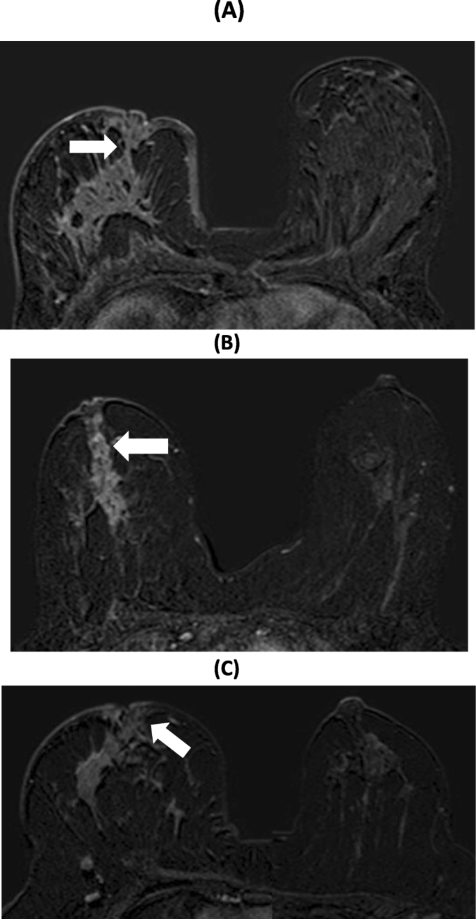 Hypertrophic breasts versus normal-sized breasts: Comparison of blood  supply to the nipple–areola complex based on DCE-MRI - ScienceDirect