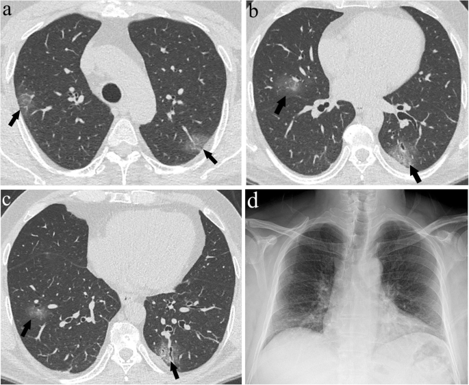 Efficacy of chest X-ray in the diagnosis of COVID-19 pneumonia: comparison  with computed tomography through a simplified scoring system designed for  triage | Egyptian Journal of Radiology and Nuclear Medicine | Full