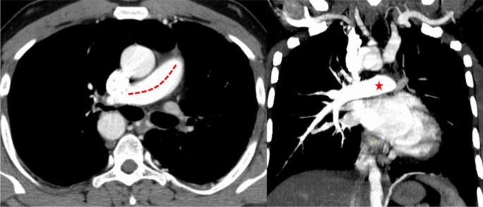Congenital cystic adenomatoid malformation associated with right aortic  arch with mirror image branching and absence of left pulmonary artery in an  adult | Egyptian Journal of Radiology and Nuclear Medicine | Full Text