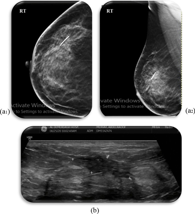 Assessment of low-cost surgical metallic clip placement for tumor  localization in BIRDAS VI breast cancer patients undergoing neoadjuvant  chemotherapy, Egyptian Journal of Radiology and Nuclear Medicine