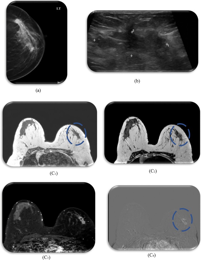 Assessment of low-cost surgical metallic clip placement for tumor  localization in BIRDAS VI breast cancer patients undergoing neoadjuvant  chemotherapy | Egyptian Journal of Radiology and Nuclear Medicine | Full  Text