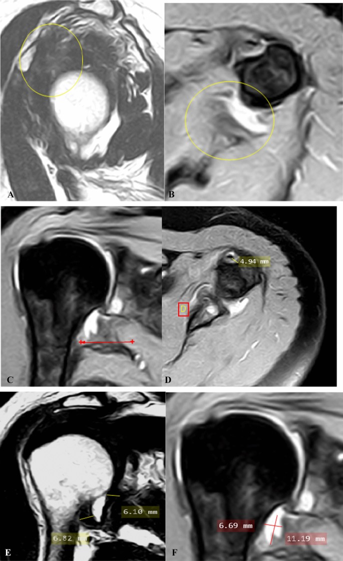 Typical magnetic resonance imaging scan showing the coracohumeral