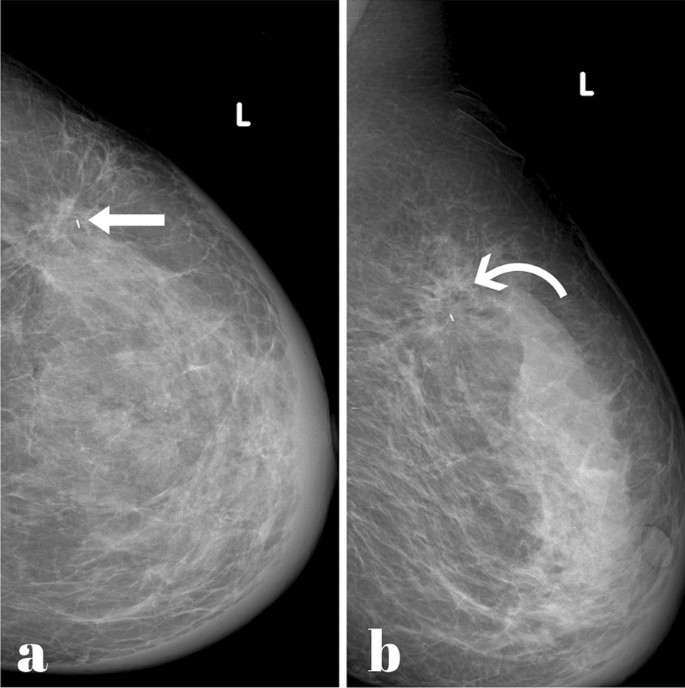 Placement of Marker Clips in breast before neoadjuvant chemotherapy 
