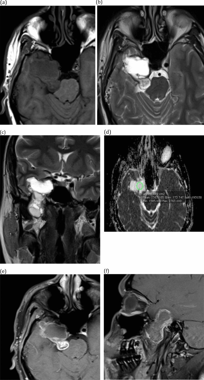 Enhancement of the trigeminal nucleus (black arrowhead), image size:685x1274