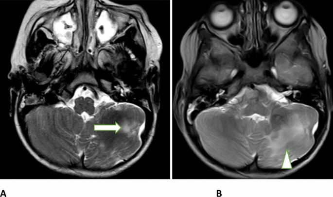 Cerebellar tubers in tuberous sclerosis complex: MRI characteristics ...