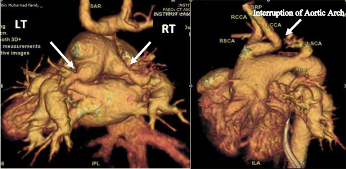 Delayed surgical repair of truncus arteriosus with interrupted aortic arch  following bilateral banding of branch pulmonary arteries: a case report |  The Cardiothoracic Surgeon | Full Text