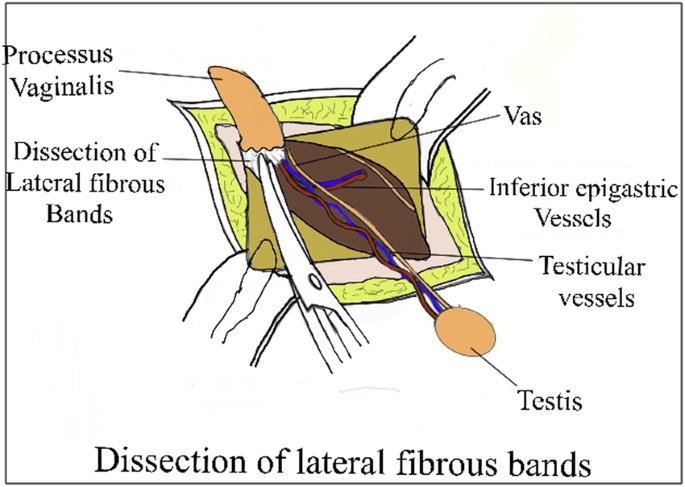 Management of high inguinal undescended testis: a review of literature |  Annals of Pediatric Surgery | Full Text