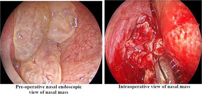 nasal papilloma