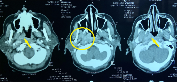 A common symptom with an uncommon diagnosis | The Egyptian Journal of  Otolaryngology | Full Text