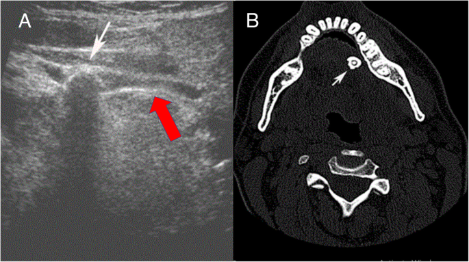 parotid gland tumor ultrasound