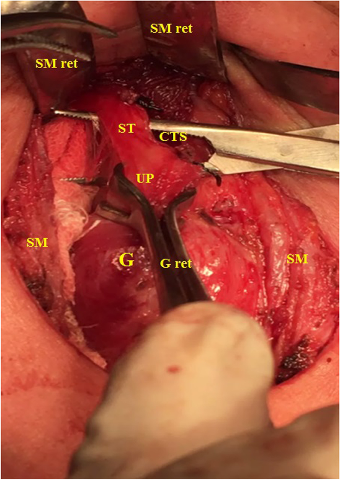 Surgical anatomy of the external branch of the superior laryngeal