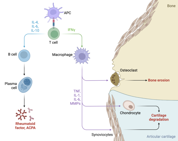 A narrative review of bone disease in spondyloarthropathy: molecular ...