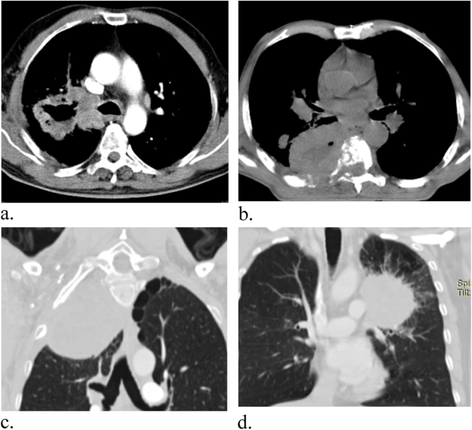 Role of CT in differentiation between subtypes of lung cancer; is it | The Egyptian Journal Bronchology | Full Text