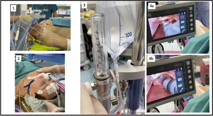 Summa Health System - Sacral Nerve Stimulator: A pacemaker for the bowel  and bladder