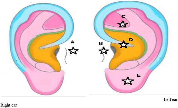 Flank pain, haematuria and poor patient compliance: beware the 'forgotten'  JJ stent!