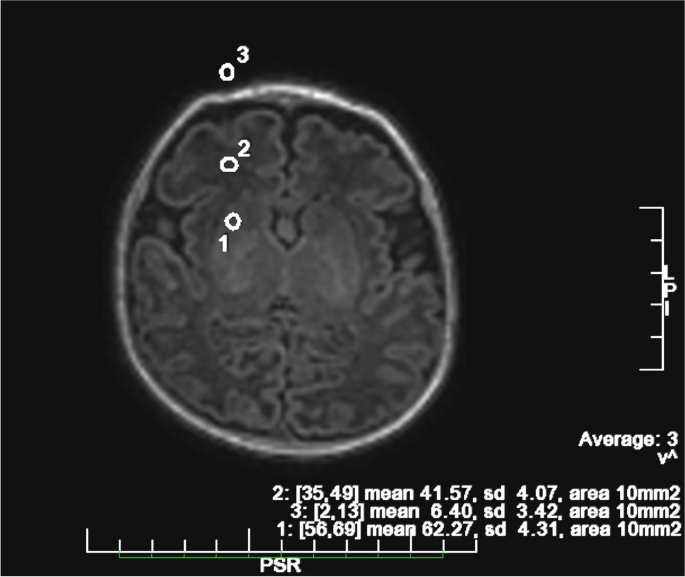 Deep sedation in lateral position for preterm infants during 