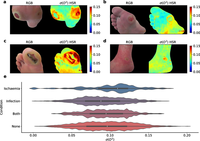 Hyperspectral reconstruction for mobile diabetic foot blood perfusion ...