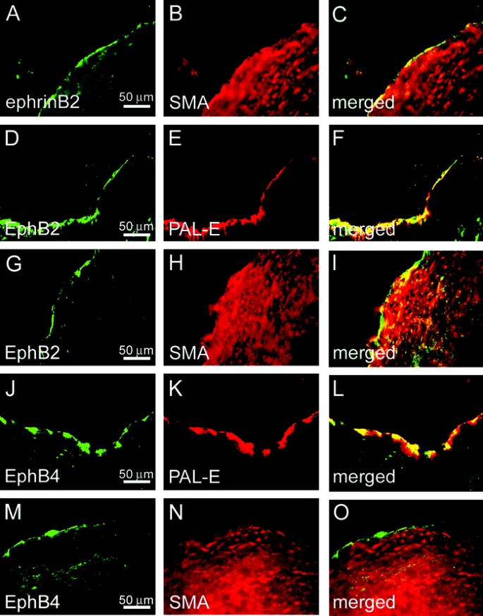 Altered Expression Patterns of EphrinB2 and EphB2 in Human Umbilical  Vessels and Congenital Venous Malformations | Pediatric Research