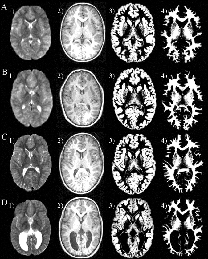 Gray Matter Volume Decrements In Preterm Children With Periventricular Leukomalacia Pediatric Research