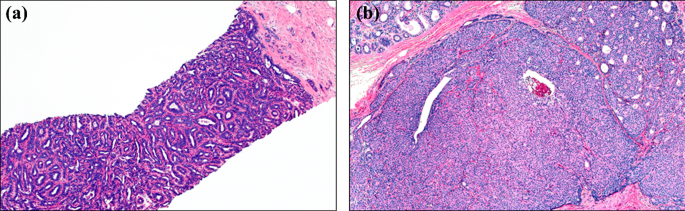 intraductal papilloma demographics