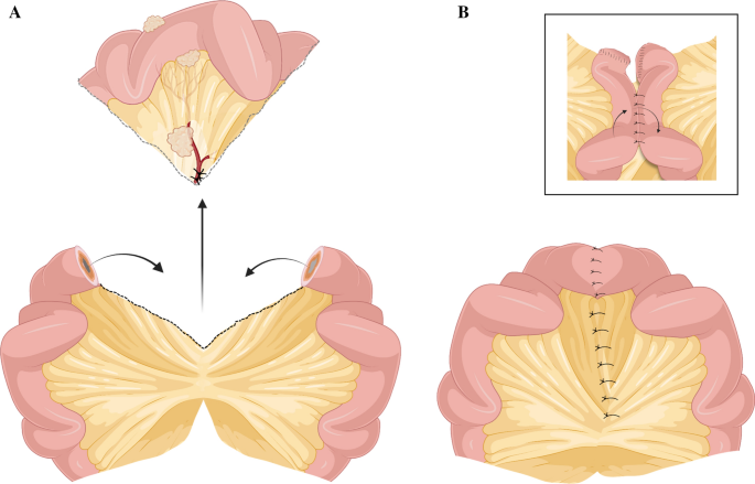 Surgery as a Principle and Technical Consideration for Primary 