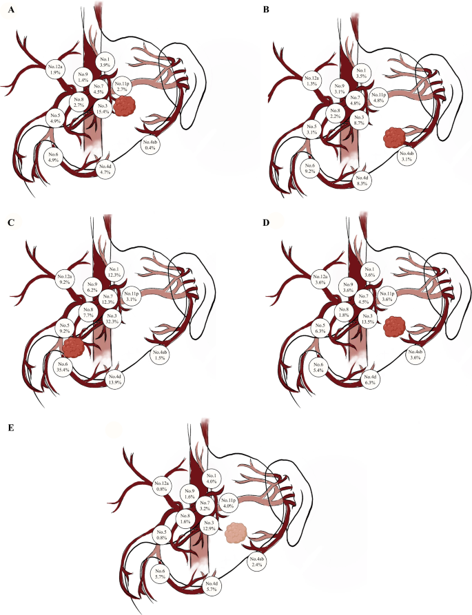 Lymph Node Metastasis Frequency and Development of Predictive Model in ...