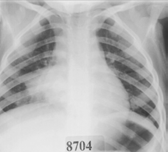 Bronkopneumonia bilateral
