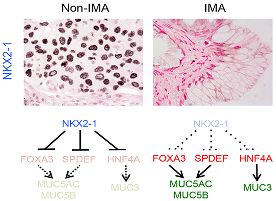 Gene signature driving invasive mucinous adenocarcinoma of the lung ...