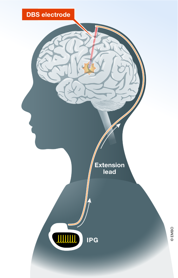 Cellular, molecular, and clinical mechanisms of action of deep brain ...