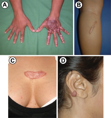 Piercing mederma scars for Does Mederma