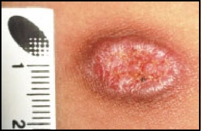 what is a parasite skin infection