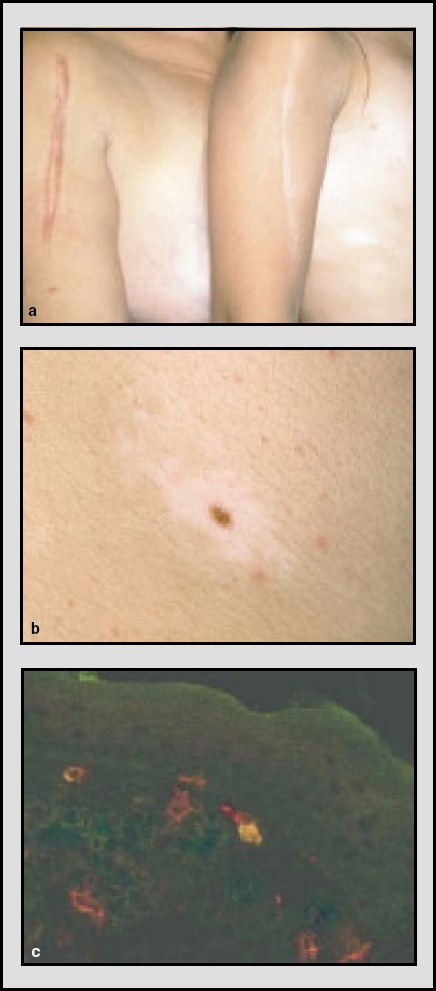melanotan 2 permanent Melanotan is trending again. As a dermatologist, I strongly need to tell  you , Its an unapproved injectable peptide, and were seeing:,  nausea  and flushing,  darkening of existing moles, 