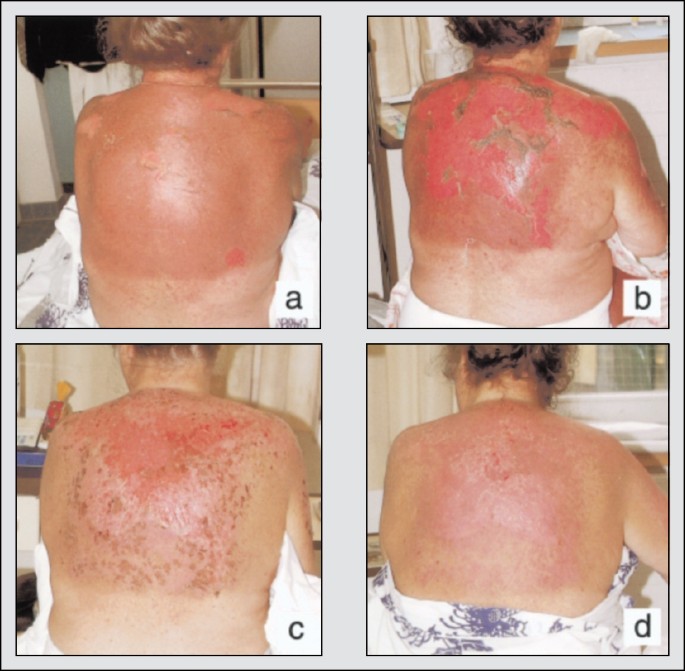 Drug-Induced Stevens-Johnson Syndrome/Toxic Epidermal Necrolysis | American  Journal of Clinical Dermatology